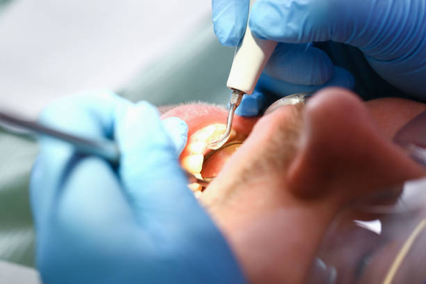 Best Emergency Gum Treatment in White Castle, LA