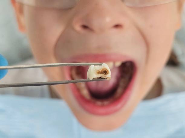 Best Emergency Dental Care for Broken or Chipped Teeth in White Castle, LA